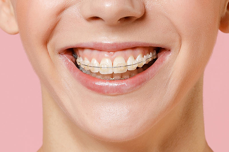 Clear Braces in Hackettstown