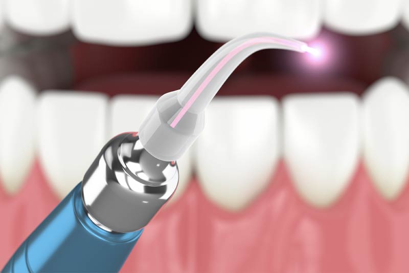 Laser Dentistry in Hackettstown