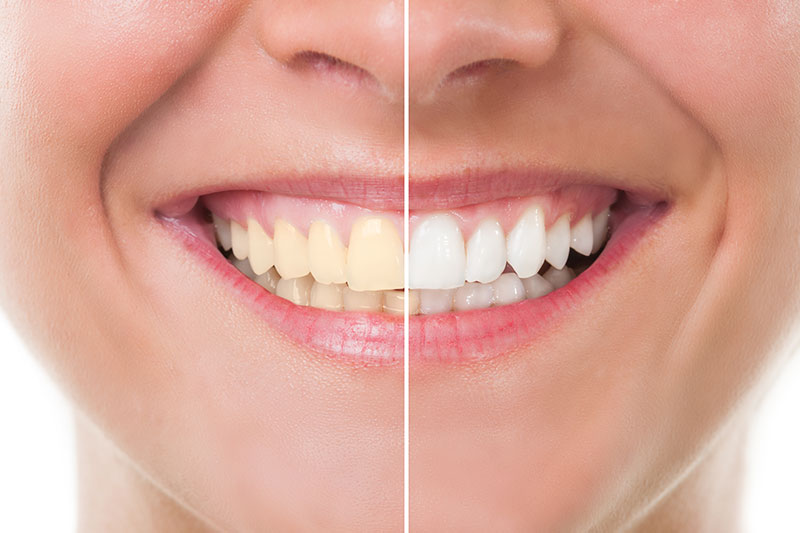 Teeth Whitening in Hackettstown